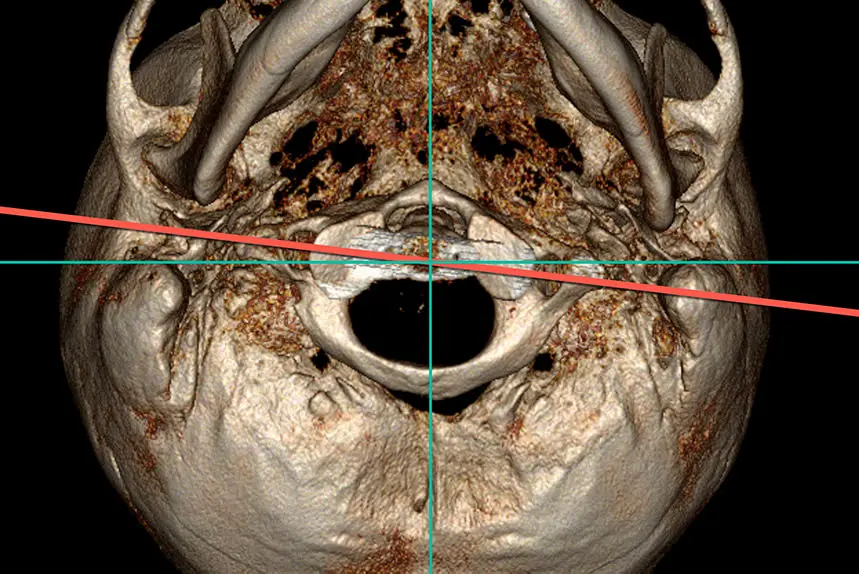 Datortomografi av Atlaskotan Datortomografi av atlaskotan