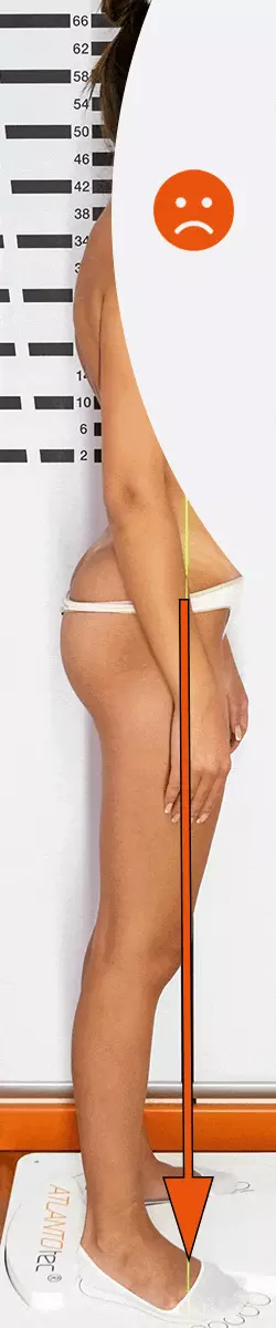 Hallux valgus hållning före och efter