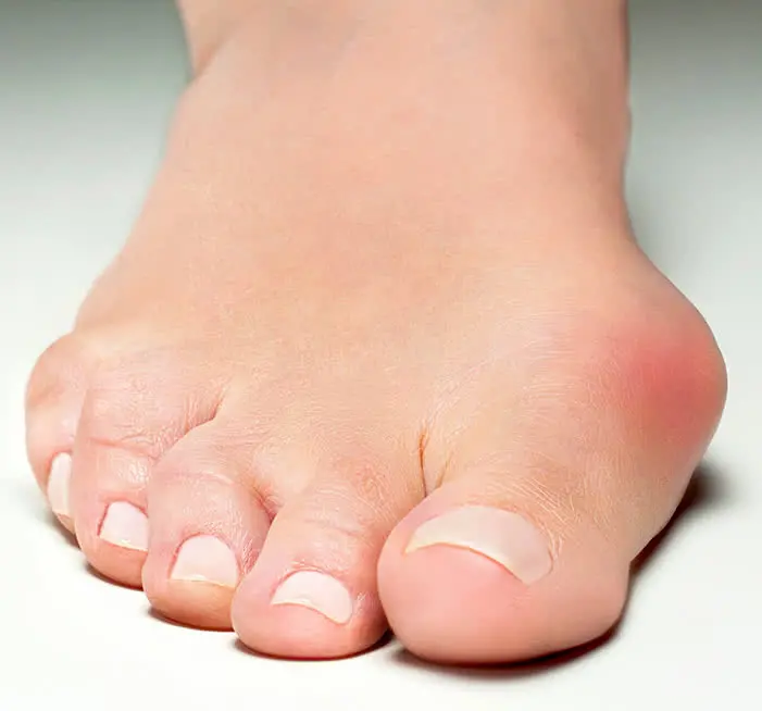 Lösningar för Hallux valgus