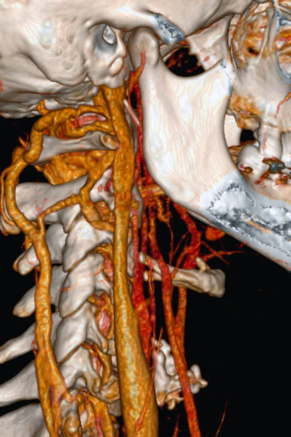 CT-angiografi av halsryggraden