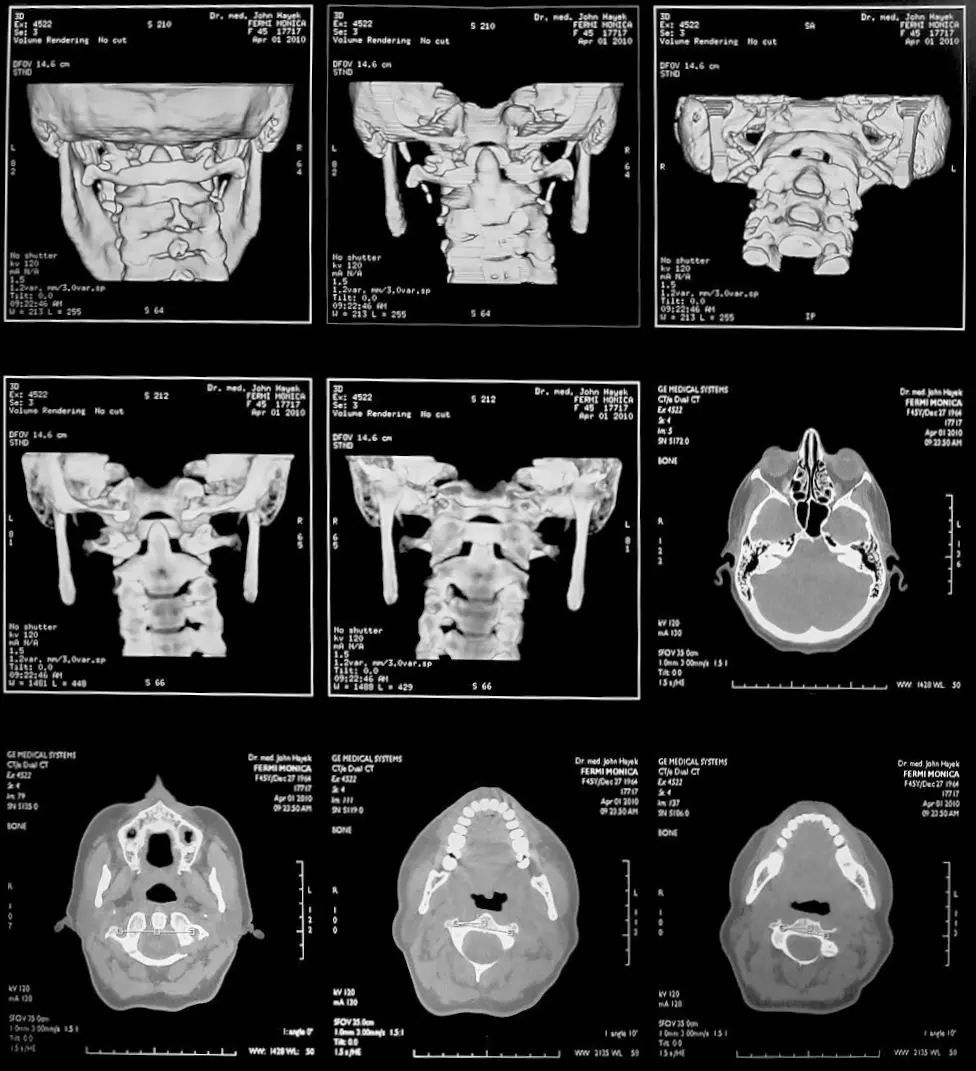 Spiral-CT / tomografi av skallen och atlaskotan