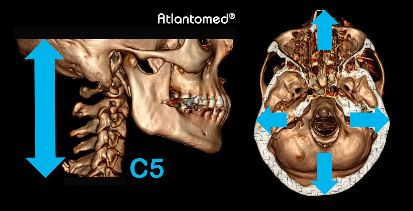 Spiral-CT av skallen och halsryggen med Atlas och Axis