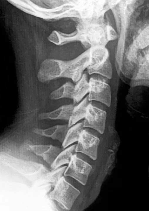 Uträtad halslordos efter en whiplashskada