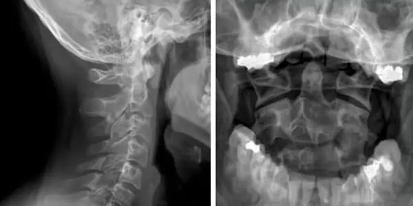 Cervikal och intraoral röntgenundersökning